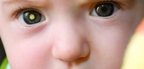 Tumor maligno nos olhos é uma das doenças  que podem ocorrer na infância 