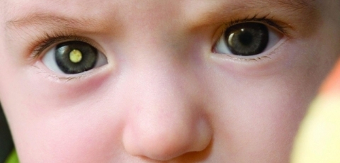 Tumor maligno nos olhos é uma dos cânceres mais comuns  antes dos quatro anos de idade 